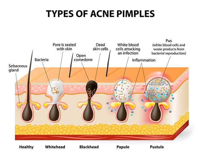 how to remove acne/pimples fast at home