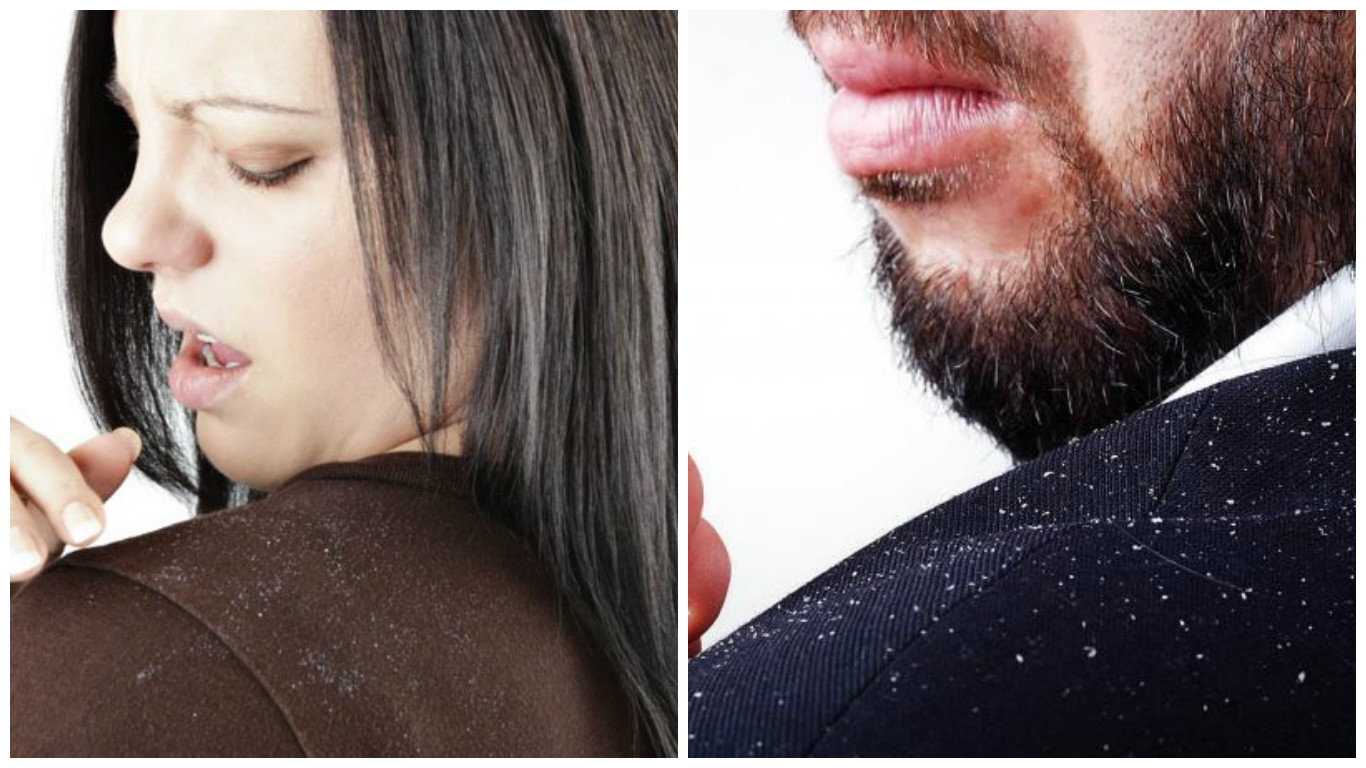 home remedies to get rid of dandruff quickly