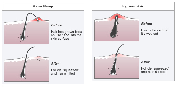 diy ingrown hair cream